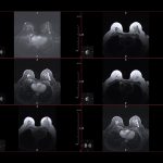 Искусственный интеллект впервые предсказал метастазирование по МРТ снимкам молочной железы