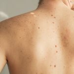 Высокодозная брахитерапия – мощный удар по раку кожи?