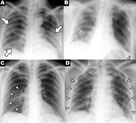 Рентген при туберкулезе