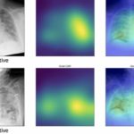 ИИ в 10 раз быстрее врачей обнаруживает COVID-19 на рентгеновских снимках