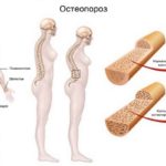 Эндокринолог МИБС осветила результаты анкетирования по остеопорозу